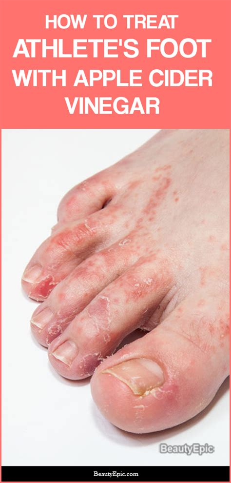 How To Get Rid Of Athletes Foot With Apple Cider Vinegar