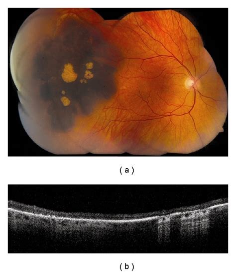Congenital Hypertrophy Of The Retinal Pigment Epithelium Chrpe A