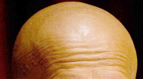 Scientists Discover ‘critical Breakthrough In Cure For Baldness Bt