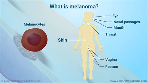 Slide Show Understanding Melanoma