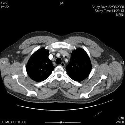 Axial Ct Of Upper Abdomen Demonstrates Mildly Enlarged Para Aortic And