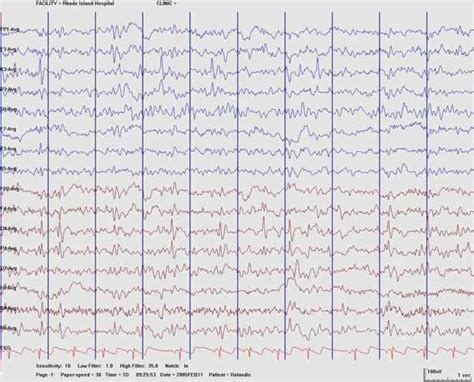 Interictal Epileptiform Abnormalities 21 Spikes And Sharp Waves
