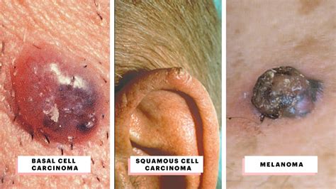 Skin Cancer A Visual Guide To Identifying Warning Signs On Your Body