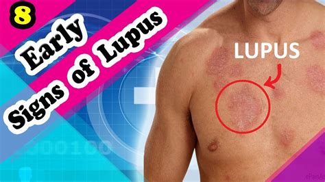 7 Signs And Symptoms Of Lupus You Should Know Patient Talk