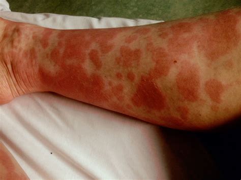 A Person With Red Spots On Their Legs