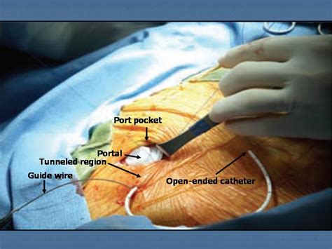 Quia Class Page Port Access Course Surgical Implantation