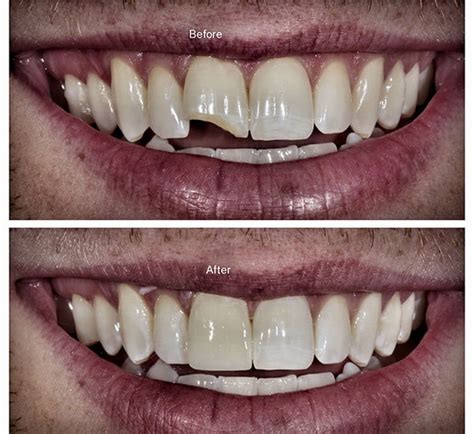 All About Front Tooth Filling Restoring Smile Solutions