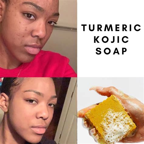 Turmeric Kojic Brightening Soap Dark Spots Dark Inner Thighs Acne