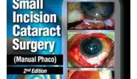 manual small incision cataract surgery