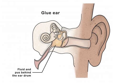 Glue Ear Kidshealth Nz