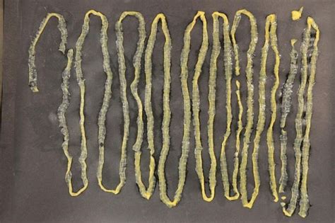 28m Live Tapeworm Removed From A Singapore Patient Who Had No Symptoms