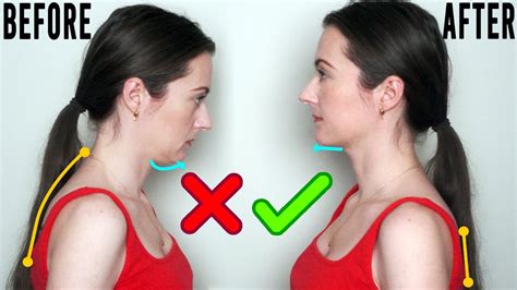 Mewing Before And After 2 Years Of Tongue Posture Exercises Youtube