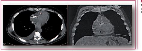 Figure 1 From Chronic Constrictive Pericarditis After Cardiac Surgery