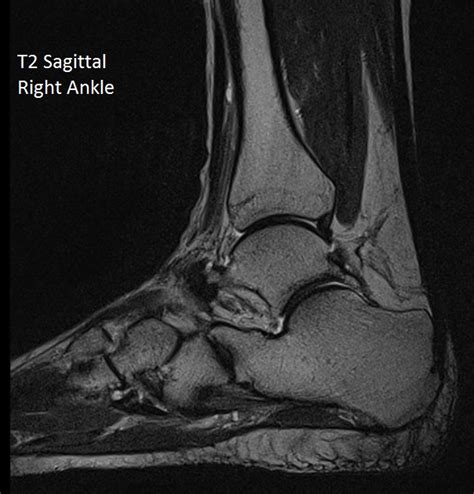 Routine ankle magnetic resonance imaging (mri) tests involve taking images of the foot and ankle in the axial, coronal, and sagittal planes the imaging process allows the magnetic field to find changes in the organ and tissue structures, identifying any sprains, ruptures, dislocations, or synovial disorders. MRI Scan Images | Worcestershire Imaging Centre