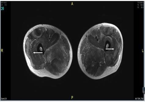 Muscular Sarcocystosis An Index Case In A Native Malaysian Bmj Case