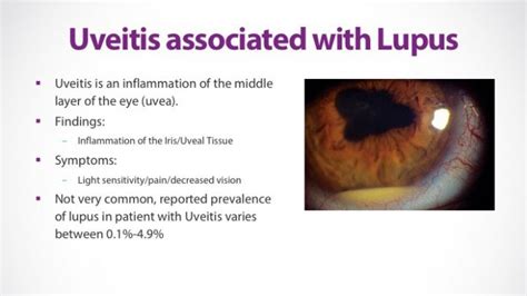 Lupus And The Eye