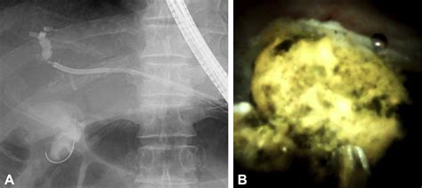 Electrohydraulic Lithotripsy Through A Fistula Of Eus Guided