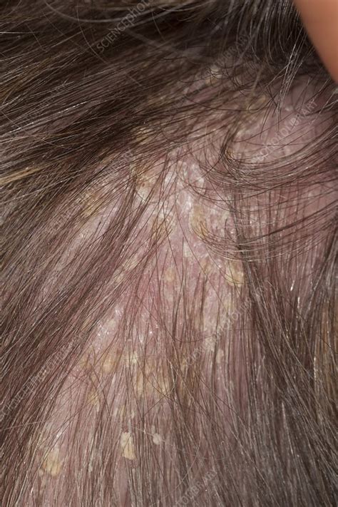 Psoriasis On The Scalp Stock Image C0148033 Science Photo Library