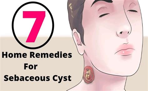 7 Effective Home Remedies For Sebaceous Cyst Home Remedies Remedies