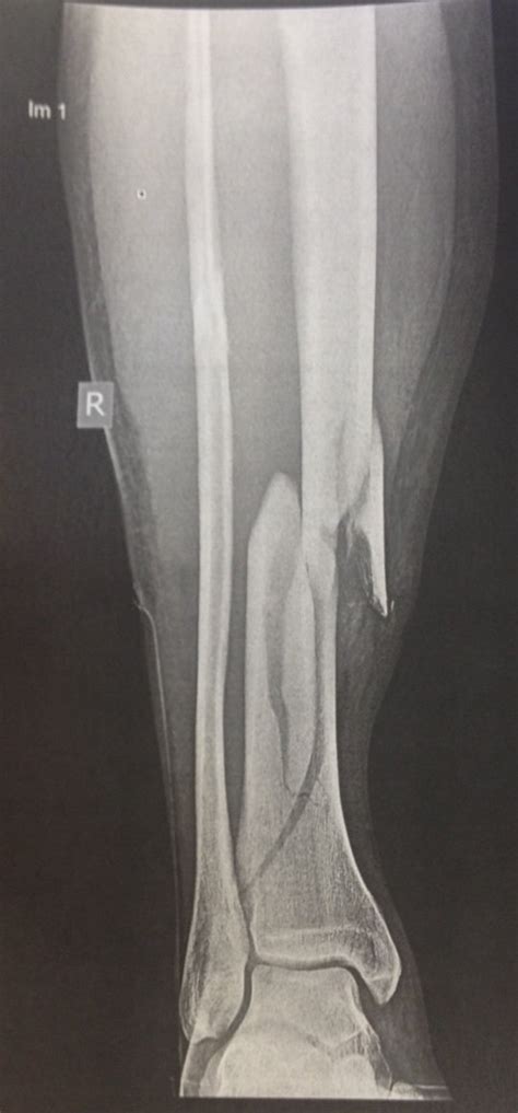 Management Of A Complex Tib Fib Fracture After Delayed Union Any
