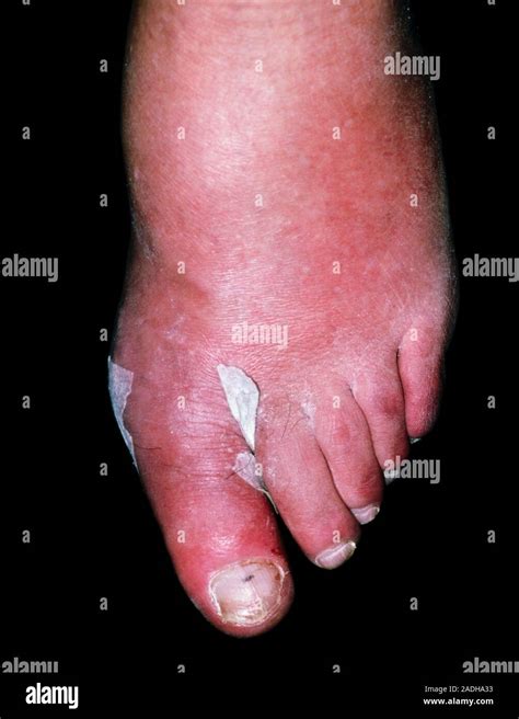 Cellulitis Cellulitis Reddened Area On The Toe Of A 75 Year Old Man