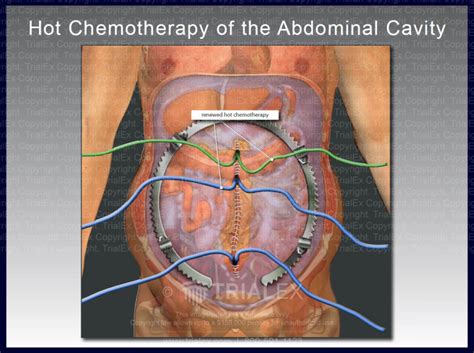 hot chemotherapy of the abdominal cavity hipec trialexhibits inc