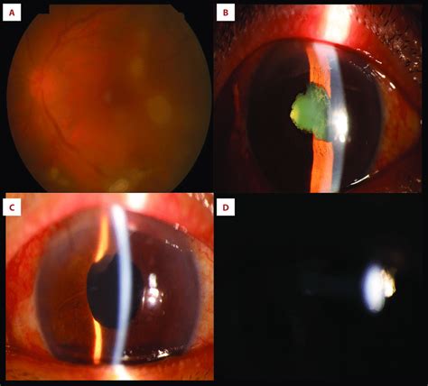 Case 2 Anterior Chamber Appearance Before Surgery Including Vitreous