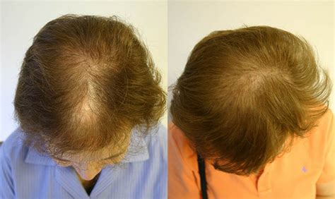 Female Hair Loss Patient 3 Limmer Hair Transplant Center
