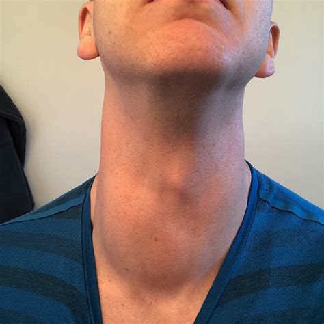 Initial Presentation Of Right Sided Neck Mass Download Scientific Diagram