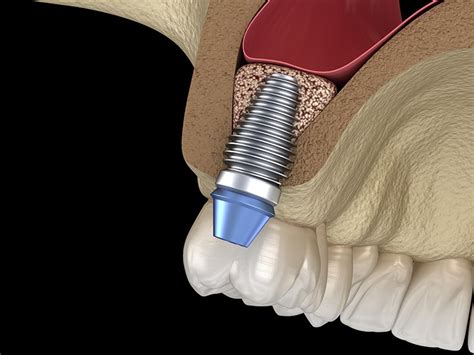 Bone Grafting And Sinus Lifts In Aberdeen Kuhn Dental Associates
