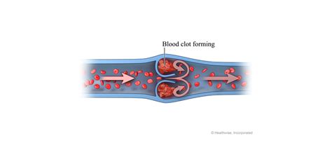 What Is The Difference Between Thrombus And Embolism