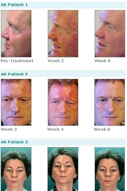 Fluorouracil 5 Topical Cream Before After