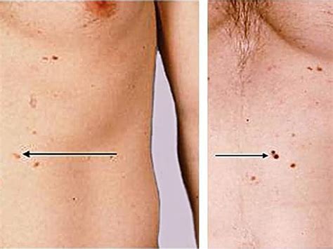 Persistent Pimple Could Be Basal Cell Carcinoma Skin Cancer Or Mole How To Tell Pictures