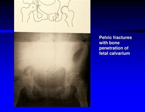 Ppt Trauma In Pregnancy Powerpoint Presentation Id4361788