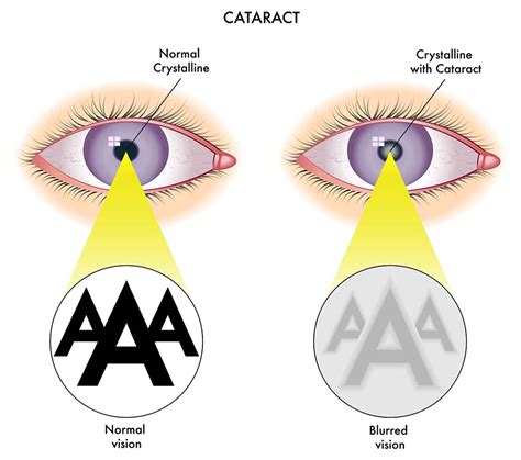 Laser Cataract Surgery Faqs New Jersey Eye Center