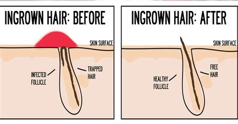 It occurs when a hair that's been removed grows back into your skin and can't emerge from its follicle. 5 Ways to Get Rid of Ingrown Hair or Razor Bumps