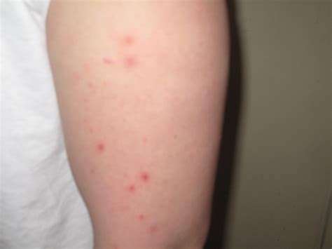 Bed Bug Bite Pictures Extermiman Pest And Wildlife