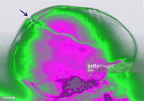 Fractured Skull Xray Photos And Premium High Res Pictures Getty Images