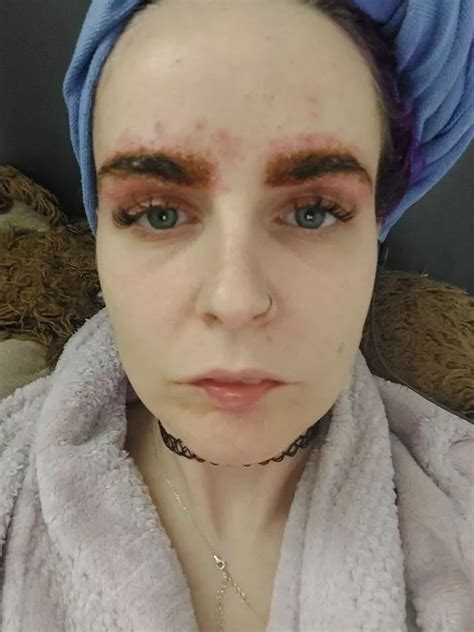 Mum Left Looking Like Quasimodo After Life Threatening Allergic Reaction To Eyebrow Tint
