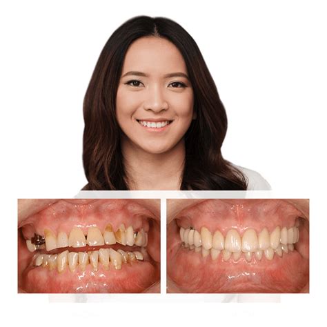 Restorative Dentistry Nashua Nh Teeth Rehabilitation