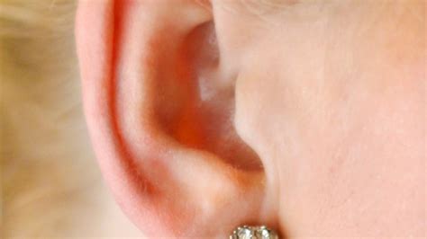 What Are The Benefits Of Ear Pinning Surgery Bala Cynwyd Ear Pinning