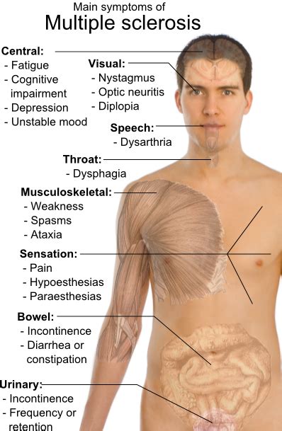 Multiple Sclerosis Main Symptoms Multiple Sclerosis Multiple