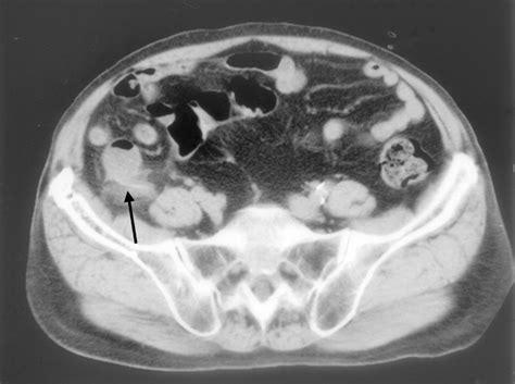 Acute Appendicitis Caused By Foreign Body Report Of Two Cases Acute
