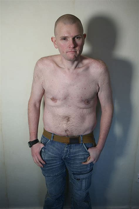 man who lost 20st and had surgery to remove excess skin is left devastated after waking up from