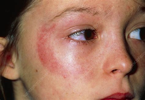 Rash On Young Girls Face Due To Allergy To Eyepad Stock Image M320