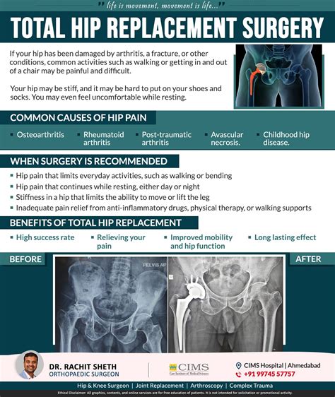 Total Hip Replacement Surgery Dr Rachit Sheth