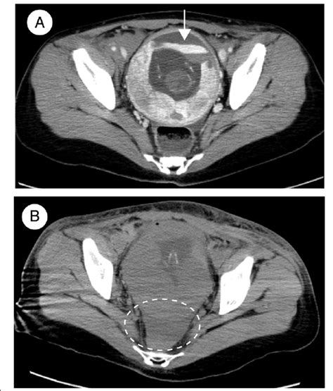 Axial Pelvic Computed Tomography CT Images At H A And H B After Download Scientific