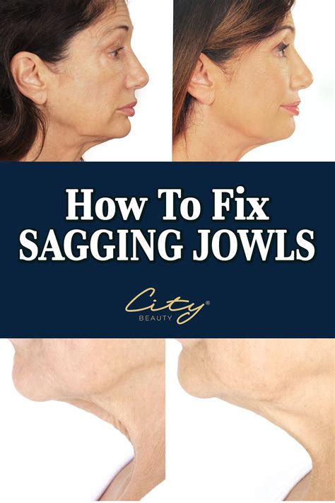 How To Fix Sagging Jowls