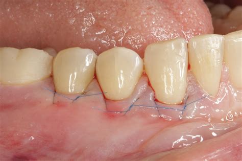 Connective Tissue Graft Issaquah Wa Northwest Periodontics And Implants