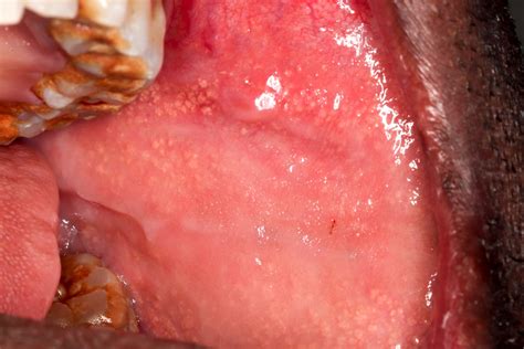 Pathology Outlines Fordyce Granules